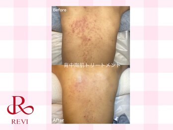 ラティーナ(Lattina)/陶肌トリートメント