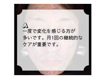 RBL 天神店/毛穴の黒ずみに効果ある？