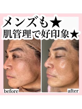 ホリシア 博多(HORISHIA)/ララピール/毛穴/ニキビケア