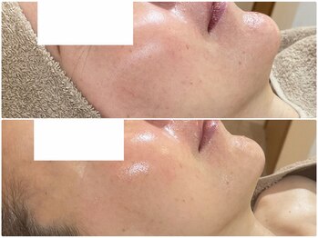 ナトラ 蔵前/50前半エイジングケア