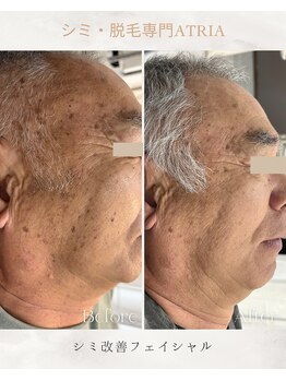 アトリア(ATRIA)/シミ改善フェイシャル