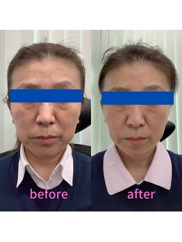 ラ シルク(La silk)/フェイシャル2回