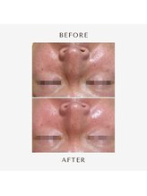 ヒヨリ(hiyori)/《before/after》毛穴洗浄