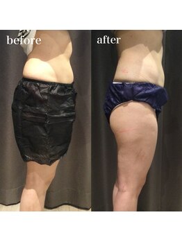 アイスタイル(i-style)/脂肪冷却/痩身ダイエット/泉大津