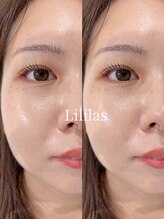 リリラース(Lililas)/
