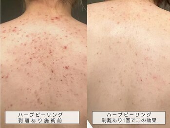 育肌美研 自由が丘サロン/背中ニキビケアハーブピーリング