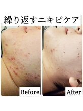 サロン ド ボーテ プルーラ(Salon de beaute PLURA)/繰り返すニキビケア