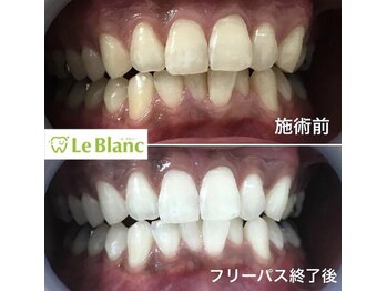 ルブラン 奈良店(Le Blanc)/セルフホワイトニング