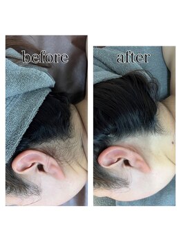 ルナ 植木店(Luna)/うなじ脱毛