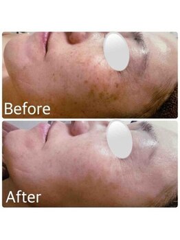 ブランシェ 富山店 × 椿/シミケア お客様