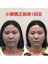 オズ六本木/六本木小顔矯正(造顔)施術1回