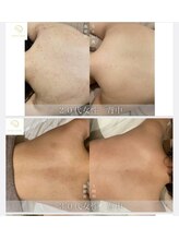 サロンド ベレーゼ/身体のシミに働きかける