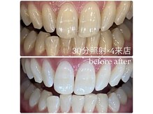 ホワイトニングルーム 横浜店(Whitening Room)/ホワイトニング/横浜