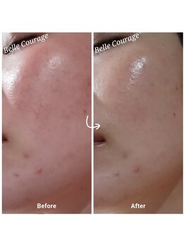 ベルクラージュ(Belle Courage)/30代　日焼け・乾燥・赤み