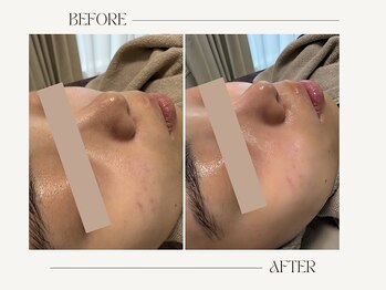 リアン(Rien)/Before/After(1回)