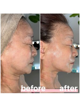 プリマ 大津店(PRIMA)/デコルテ・首にも効果アリ◎