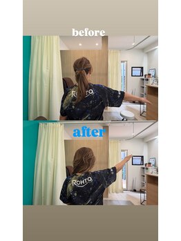 西宮ヤノ整骨院/50代女性痛みで上げられない肩が