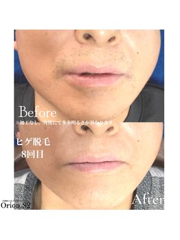オリオンドットエスツー(Orion.S2)/【Before→After】