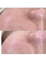 プアラ(puala)/ビフォーアフター