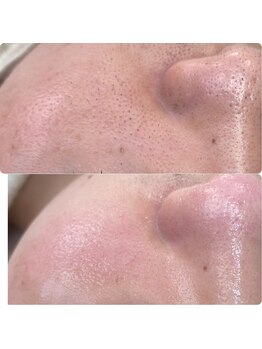 プアラ(puala)/ビフォーアフター