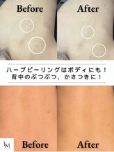 ライム 天神(LIME) 背中 ニキビケア