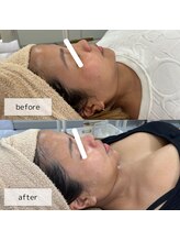 ヴィーナス(Venus)/ヒト幹細胞×美肌菌ピーリング