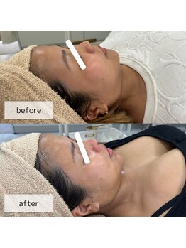 ヴィーナス(Venus)/ヒト幹細胞×美肌菌ピーリング