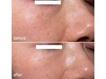 アプローズ(APPLAUSE)/エクソソーム　メンズ美容