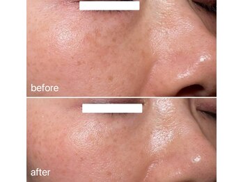 アプローズ(APPLAUSE)/エクソソーム メンズ美容