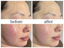 アリエス/ハイドラ×顔脱毛