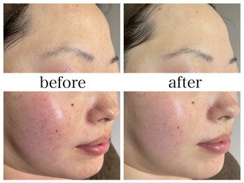 アリエス/ハイドラ×顔脱毛