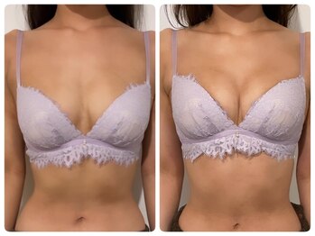 モナンジュ(ramonange)/バストアップbefore after