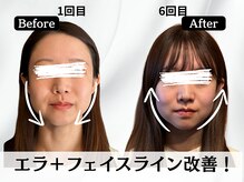 ハリユナイテッド 原宿鍼灸 整体院(HALI UNITED)/エラ＋フェイスライン改善！