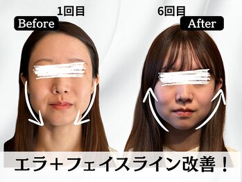 ハリユナイテッド 原宿鍼灸 整体院(HALI UNITED)/エラ+フェイスライン改善!