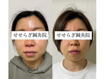 せせらぎ鍼灸院/小顔になりたい貴方へ