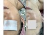 か○ぱん＆シミに【医療提携】血流改善×ヒト幹細胞導入[かさぶたになる]