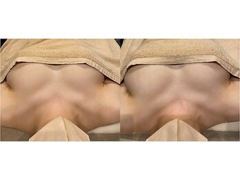 ルミエール(Lumiere)/【倉敷市】バストアップ施術事例