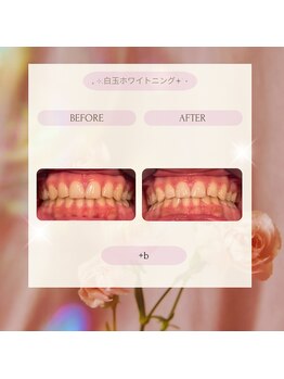 プラスビーセルフ(+b self)/ホワイトニングビフォーアフター