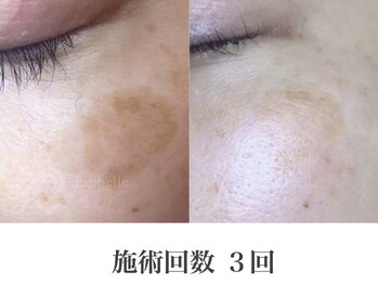 パルファンカルム 駅西本町店/自分至上最高峰の肌へ!