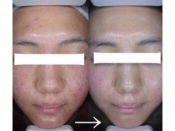 マイン 幸店/ドクターリセラADS美肌活性