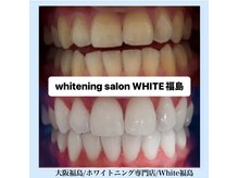 ホワイトニングサロン ホワイト(WHITE)/セルフホワイトニング/大阪/福島