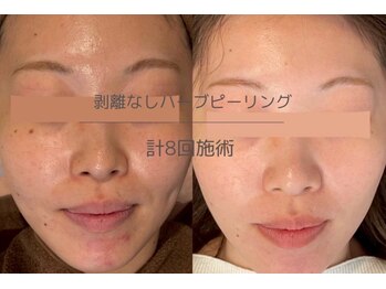 ヒジ(Life Salon)/ハーブピーリング