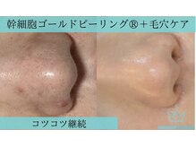 リメイクビューティークリニック(REMAKE BEAUTY CLINIC)/毛穴の黒ずみザラザラ毛穴