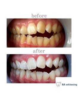 NA ホワイトニング 川崎溝の口店/ホワイトニング/川崎/溝の口