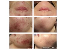 ベビースキン(baby skin)/肌改善