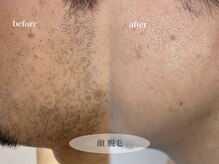 ビジュー(bjyou)/メンズヒゲ脱毛