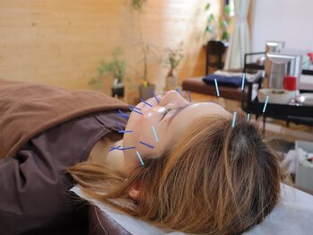 こと鍼灸院・整骨院/電気刺激を頭皮に流します