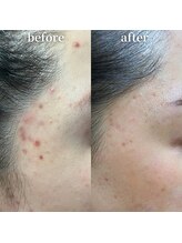 エステティックサロン ナチュラーレ/ニキビ・シミ