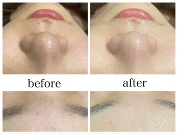 アリエスの写真/その黒ずみ産毛と汚れが原因かも？！【美容液毛穴洗浄ハイドラ×顔脱毛】でポツポツ毛穴卒業！