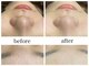 アリエスの写真/その黒ずみ産毛と汚れが原因かも？！【美容液毛穴洗浄ハイドラ×顔脱毛】でポツポツ毛穴卒業！
